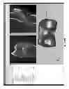 Fig. 256 - PATIENT-ADAPTED AND IMPROVED ARTICULAR IMPLANTS, DESIGNS AND RELATED GUIDE TOOLS
