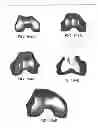 Fig. 262 - PATIENT-ADAPTED AND IMPROVED ARTICULAR IMPLANTS, DESIGNS AND RELATED GUIDE TOOLS