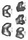 Fig. 263 - PATIENT-ADAPTED AND IMPROVED ARTICULAR IMPLANTS, DESIGNS AND RELATED GUIDE TOOLS