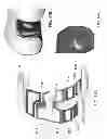 Fig. 64 - PATIENT-ADAPTED AND IMPROVED ARTICULAR IMPLANTS, DESIGNS AND RELATED GUIDE TOOLS