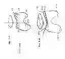 Fig. 67 - PATIENT-ADAPTED AND IMPROVED ARTICULAR IMPLANTS, DESIGNS AND RELATED GUIDE TOOLS