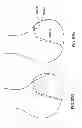 Fig. 75 - PATIENT-ADAPTED AND IMPROVED ARTICULAR IMPLANTS, DESIGNS AND RELATED GUIDE TOOLS