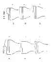 Fig. 98 - PATIENT-ADAPTED AND IMPROVED ARTICULAR IMPLANTS, DESIGNS AND RELATED GUIDE TOOLS
