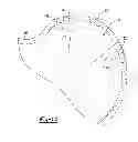 Fig. 09 - Method and apparatus for augumenting bone defects