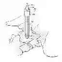 Fig. 01 - SURGICAL SITE ACCESS SYSTEM AND DEPLOYMENT DEVICE FOR SAME