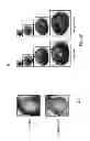 Fig. 03 - Therapeutic application of adiponectin in patients with ventricular fibrillation
