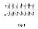 Fig. 02 - Pharmaceutical Composition Comprising Cinchonains Ia and Ib, Process For Preparing An Epimeric Mixture of Cinchonains Ia and Ib, Use and Method for Reverting/Combating Ventricular Fibrillation