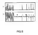 Fig. 09 - Pharmaceutical Composition Comprising Cinchonains Ia and Ib, Process For Preparing An Epimeric Mixture of Cinchonains Ia and Ib, Use and Method for Reverting/Combating Ventricular Fibrillation