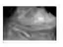 Fig. 05 - Method for evaluating blush in myocardial tissue
