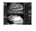 Fig. 07 - Method for evaluating blush in myocardial tissue