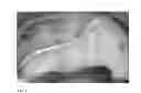 Fig. 12 - Method for evaluating blush in myocardial tissue