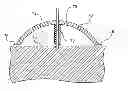 Fig. 01 - Intradermal delivery device