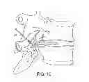 Fig. 09 - Pain management using cryogenic remodeling