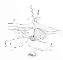Fig. 03 - Methods and systems for treating complex fistulae