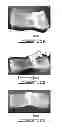 Fig. 07 - Fusionless vertebral physeal device