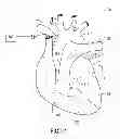 Fig. 02 - Systems for using a pulmonary artery electrode
