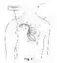 Fig. 02 - Criteria for optimal electrical resynchronization derived from multipolar leads or multiple electrodes during biventricular pacing