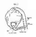 Fig. 02 - APPARATUS AND METHOD FOR CONNECTING A CONDUIT TO A HOLLOW VESSEL