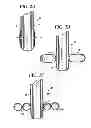 Fig. 03 - APPARATUS AND METHOD FOR CONNECTING A CONDUIT TO A HOLLOW VESSEL