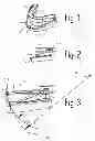 Fig. 02 - Oral device for improvement of breathing