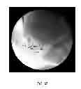 Fig. 13 - LUNG BIOPSY NEEDLE