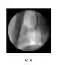 Fig. 22 - LUNG BIOPSY NEEDLE