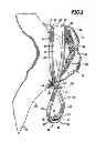 Fig. 02 - Surgical clip and surgical method for treating an aneurysum