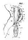 Fig. 06 - Surgical clip and surgical method for treating an aneurysum