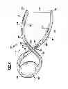 Fig. 07 - Surgical clip and surgical method for treating an aneurysum