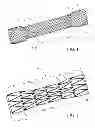 Fig. 02 - ENDOLUMINAL PROSTHESIS HAVING ANTI-MIGRATION COATING