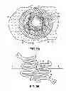 Fig. 06 - COLD-MOLDING PROCESS FOR LOADING A STENT ONTO A STENT DELIVERY SYSTEM