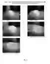 Fig. 43 - Foamable formulation