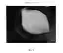 Fig. 77 - Foamable formulation