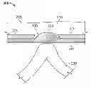 Fig. 01 - Hernia mesh apparatus and method