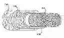 Fig. 01 - Percutaneous methods and apparatus for creating native tissue venous valves