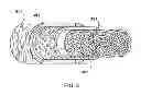 Fig. 03 - Percutaneous methods and apparatus for creating native tissue venous valves