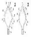Fig. 06 - Percutaneous methods and apparatus for creating native tissue venous valves