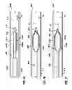 Fig. 12 - Percutaneous methods and apparatus for creating native tissue venous valves