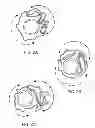 Fig. 04 - Uniform crimping and deployment methods for polymer scaffold