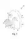 Fig. 02 - Method of implanting a glenoid defect-filling component
