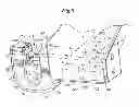 Fig. 04 - Mechanical method and apparatus for bilateral tissue fastening