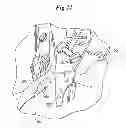 Fig. 16 - Mechanical method and apparatus for bilateral tissue fastening