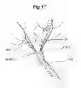 Fig. 41 - Mechanical method and apparatus for bilateral tissue fastening