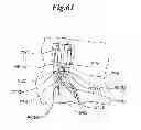 Fig. 45 - Mechanical method and apparatus for bilateral tissue fastening