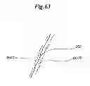Fig. 47 - Mechanical method and apparatus for bilateral tissue fastening