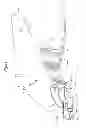 Fig. 48 - Mechanical method and apparatus for bilateral tissue fastening