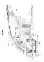 Fig. 50 - Mechanical method and apparatus for bilateral tissue fastening