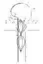 Fig. 01 - Vascular remodeling device