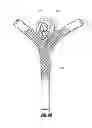Fig. 05 - Vascular remodeling device