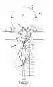 Fig. 19 - Vascular remodeling device